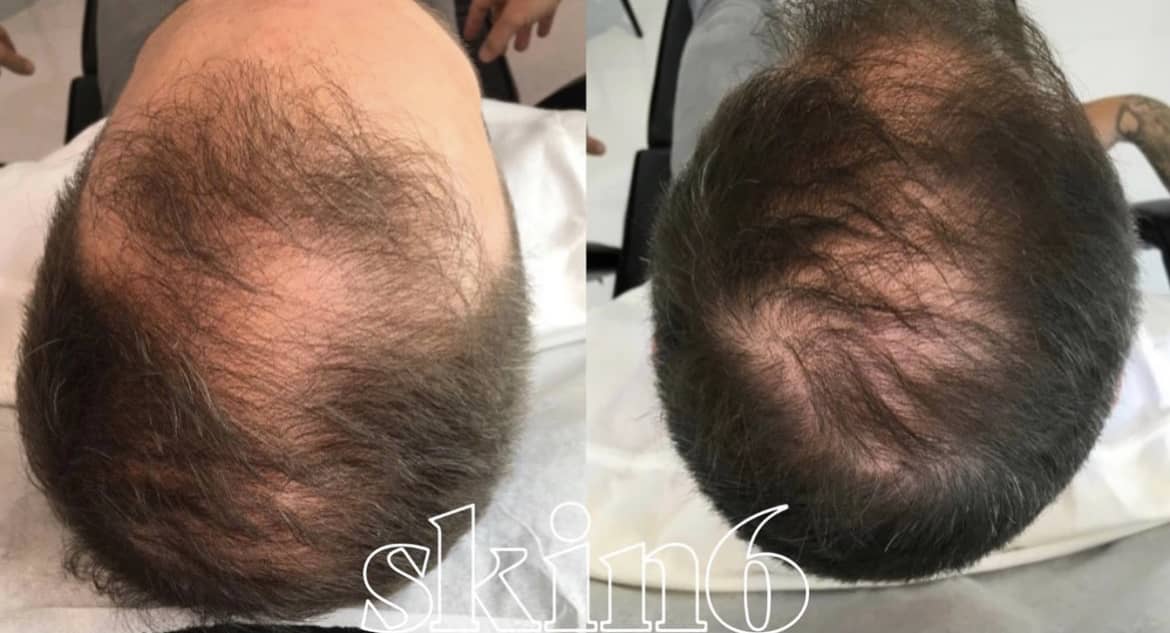 Non Surgical Hair Restoration Treatment in Toronto | Skin6